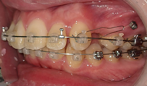 歯科矯正用アンカースクリューを併用した治療